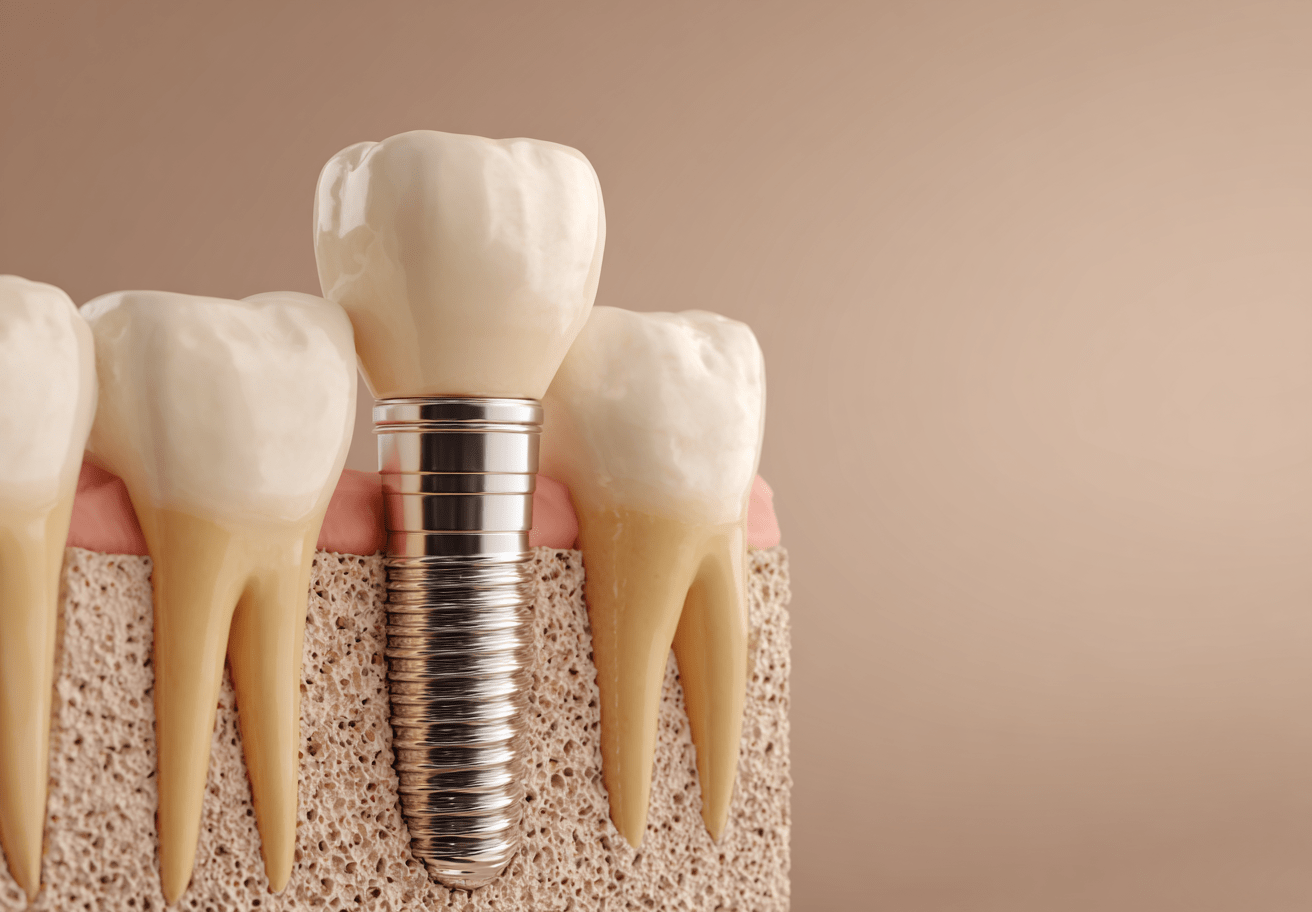 부천역치과임플란트